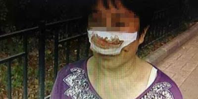 Gara Gara Tidak Mengangkat Telpon, Pria Ini Nekat Makan Hidung Istrinya