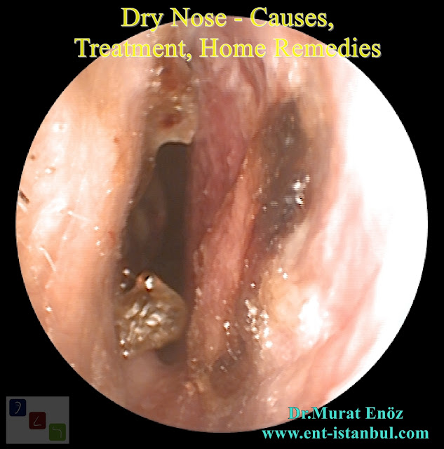 Dry Nose - Causes, Treatment, Home Remedies