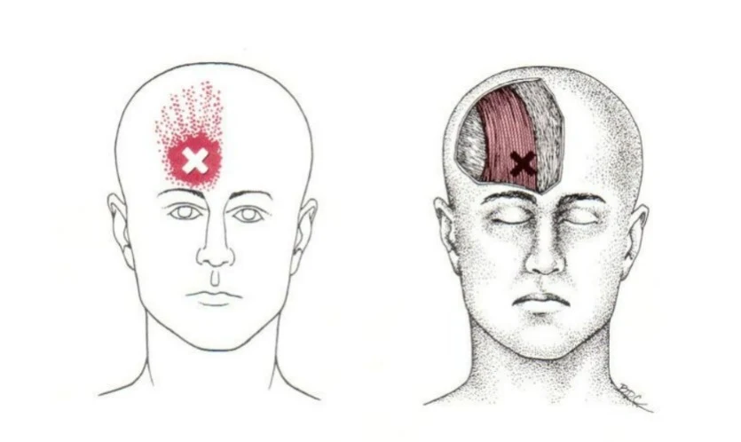 dolor cervical y cefalea - occipito frontal - mc spa