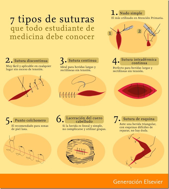 7 tipos de suturas que todo estudiante de medicina debe conocer (Infografía)