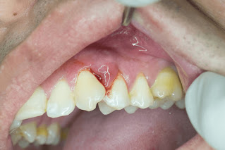 Áp xe răng có nguy hiểm không-1
