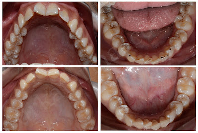 Treatment for Multiple Decayed Teeth
