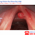 Viêm họng polyp và triệu chứng 