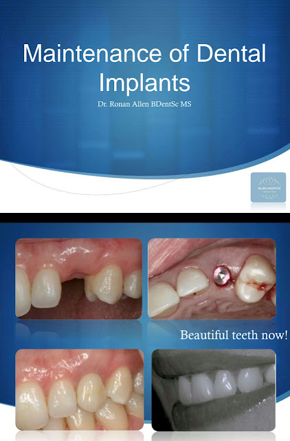 DENTAL IMPLANT MAINTENANCE - Burlington Dental Clinic