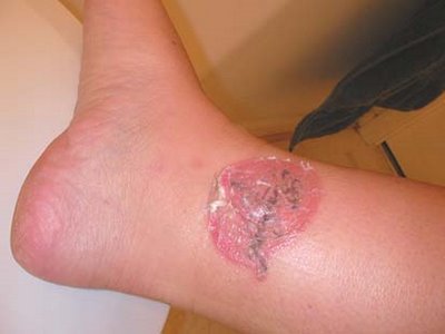 Dermabrasion tattoo removal is the most effective method of tattoo removal.