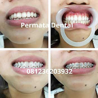 pasang behel gigi bali| pasang behel gigi denpasar| pasang behel gigi kute| pasang behel gigi nusadua | pasang behel gigi badung | pasang behel gigi gatsu| pasang behel gigi jimbaran | pasang behel gigi murah | pasang behel gigi mudah | pasang behel gigi cepat | pasang behel gigi aman | pasang behel gigi atas | pasang behel gigi bawah | pasang behel gigi atas bawah | pasang behel fashion | pasang behel gigi | pasang behel gigi gingsul | pasang behel gigi cantik | pasang behel gigi perawatan | pasang behel ahli gigi | pasang behel gigi berlubang | pasang behel gigi renggang | gambar pasang behel gigi | foto pasang behel gigi | pasang behel gigi kelinci | pasang behel gigi lepas pasang | pasang behel gigi promo | behel gigi untuk gigi tonggos | pasang behel elastis | pasang behel gigi ompong | pasang behel gigi hiasan| gambar foto trand behel bracket kawat gigi fashion