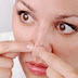 Cara Menghilangkan Komedo Membandel Di wajah Serta Area Hidung Dengan Cepat