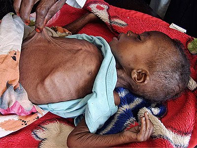 Starvation in Somalia