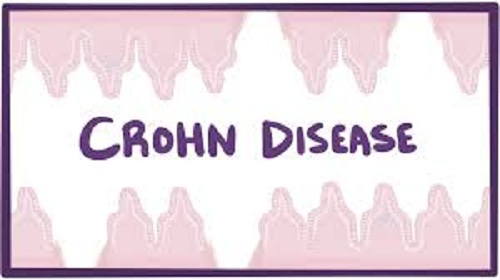 Tout sur La Maladie de Crohn | Everything about Crohn's disease 