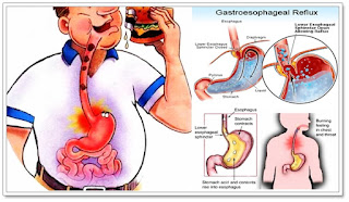 Penyakit Gerd, Ini  Ciri-Cirinya