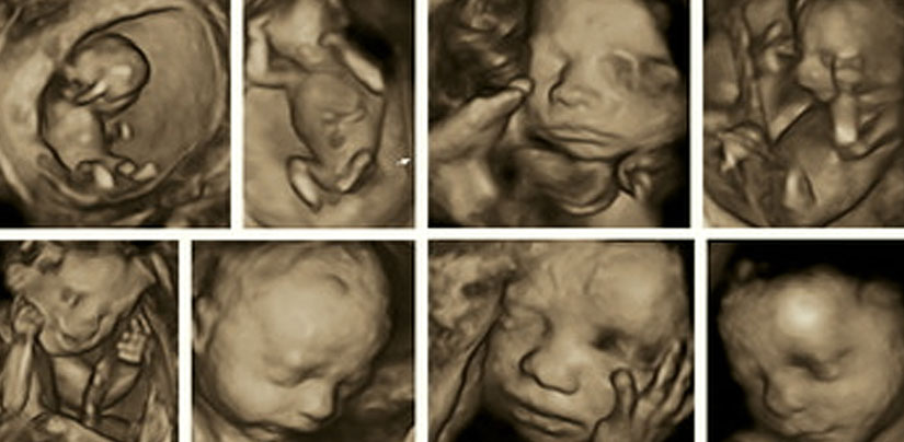 Volume (4D) Ultrasound in Pregnancy