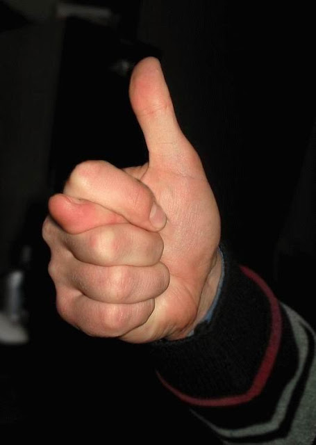 Six Finger Man Having Two Thumbs - info24seven