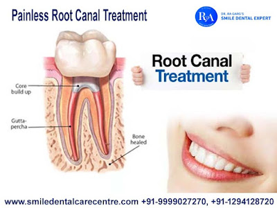 Painless Root Canal Treatment In India