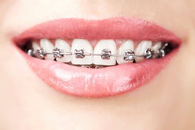 Phương pháp niềng răng khi mất răng 6 chuẩn công nghệ 2