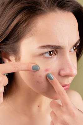 Pimples on Face Removal Tips