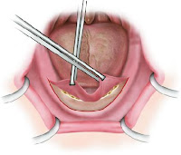 Torus Removal Surgery