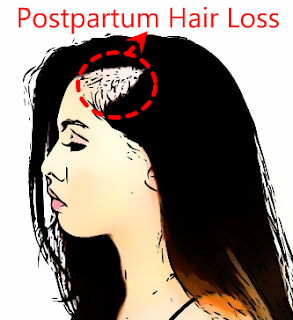 postpartum hair loss