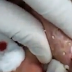 Ovako izgleda ekstremno ceđenje bubuljica (VIDEO)