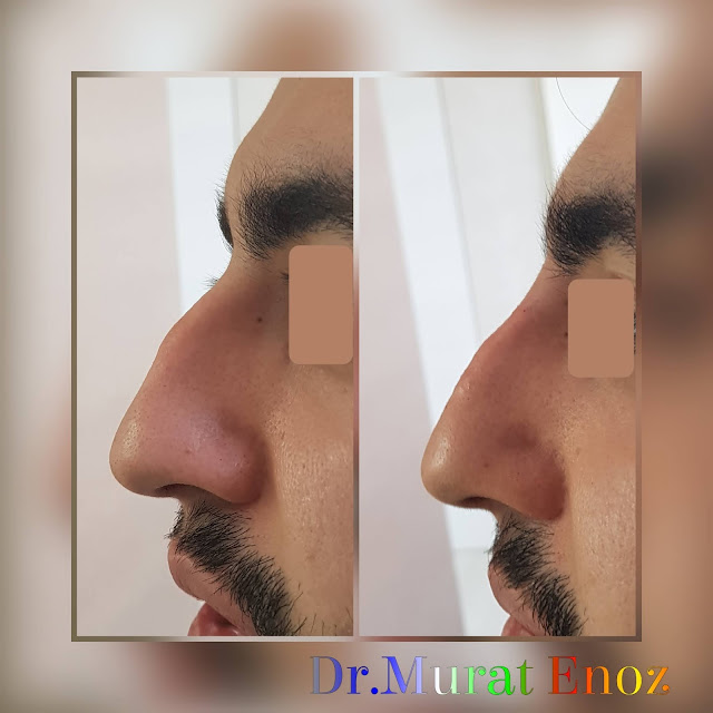 Non surgical nose job with filler, limited filler injection to the nose