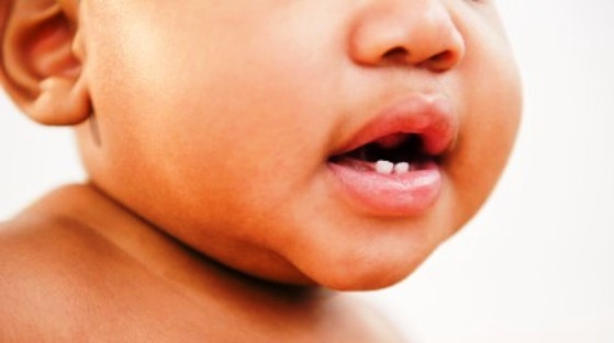 Baby's First Tooth: Health Tip