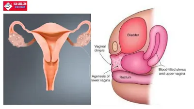 What is Vaginal Agenesis?