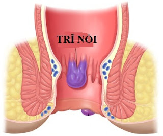 Tìm hiểu thông tin về bệnh trĩ nội