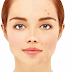 Best Acne Scar Removal | for Acne Free Skin