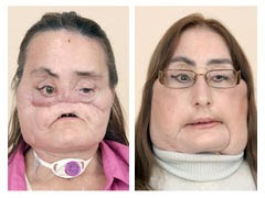 Connie Culp Before And After