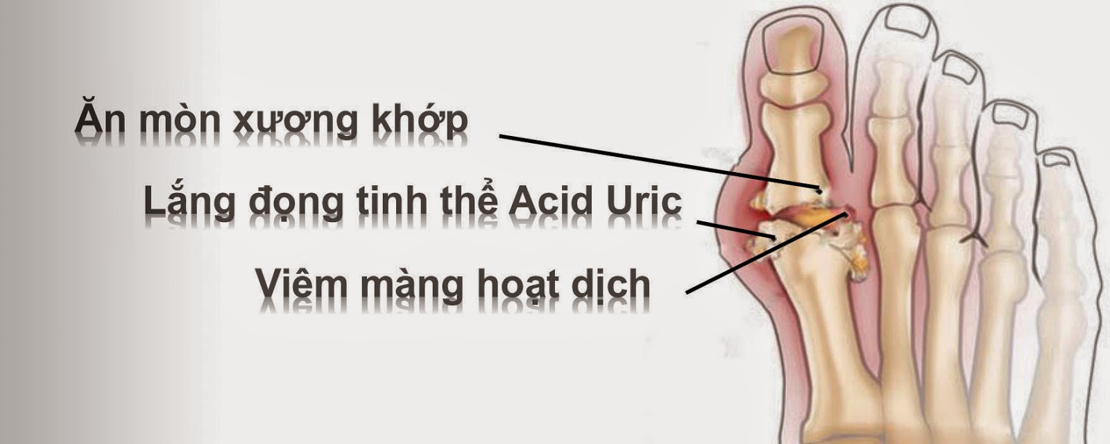 DẤU HIỆU BỆNH GOUT