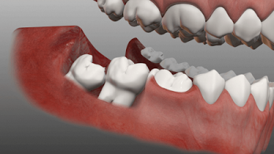  Nhổ răng khôn số 8 có ảnh hưởng gì không?