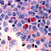 First cancer gene therapy to treat leukaemia approved by US regulators