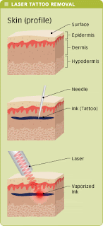 Laser Tattoo Removal