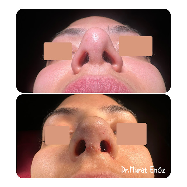 L-shaped silicone nasal implant, Silicone nose implant, Tertiary revision rhinoplasty,3rd Revision Nose Job, before and after