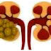 Signs and symptoms of kidney stone