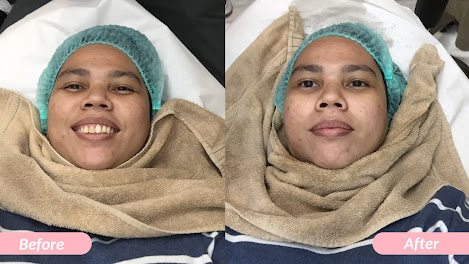 Before-after Chemical Peeling Glow treatment