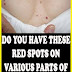 Do You Have These Red Spots On Various Parts Of Your Body? Should You Worry? What Should You Do?