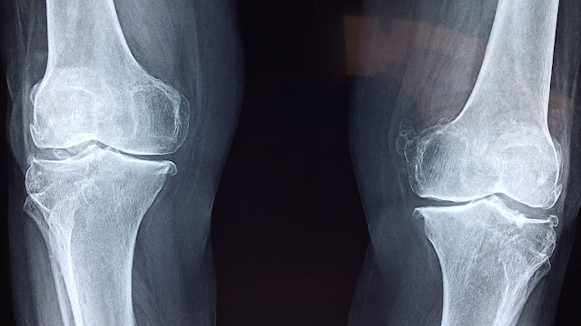 Causes and symptoms of osteoarthritis and methods of treatment | healthy care