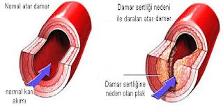 Damar sertliği ve tedavisi