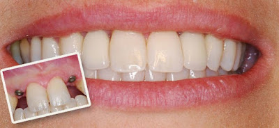 Răng toàn sứ venus có hiệu quả gì ?