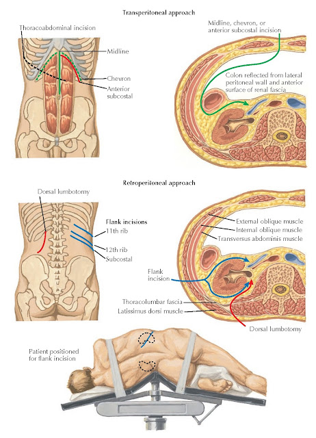 OPEN NEPHRECTOMY: INCISIONS FOR TRANSPERITONEAL AND RETROPERITONEAL APPROACHES