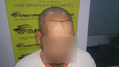 Hair transplant result 