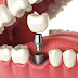 Chi phí trồng răng implant là bao nhiêu ?