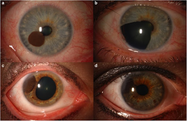 Intraocular Melanoma Treatment