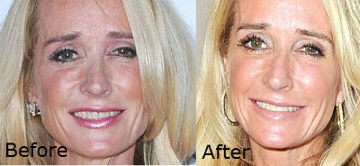 Kim Richard before and after photos cosmetic surgery nose job