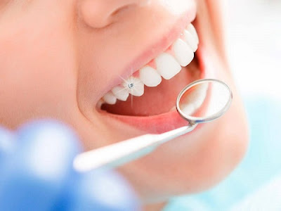Quy trình bọc răng sứ cho răng khểnh an toàn 2