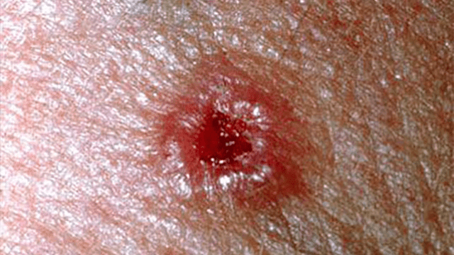 skin-cancer-risk-factors