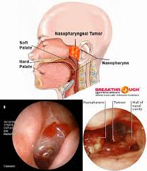 Pengobatan Tradisional Kanker Nasofaring