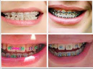  Terms and Indications of Behel Dental Installation (Bracket)