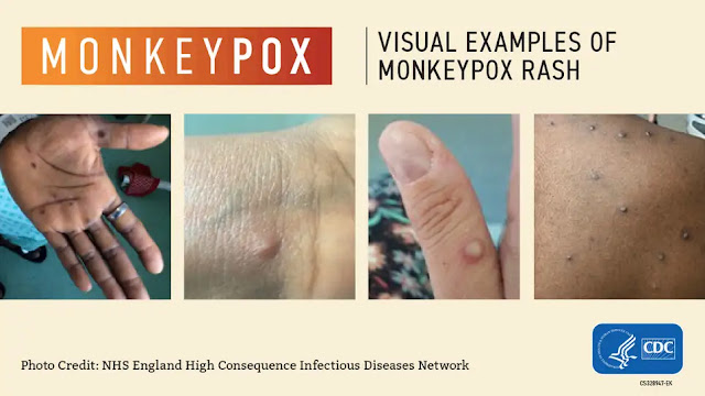 Imagem : CDC - monkeypox