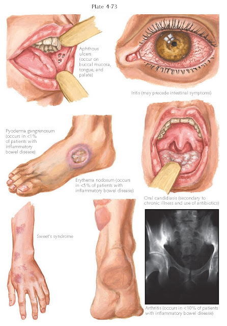 MUCOCUTANEOUS MANIFESTATIONS OF INFLAMMATORY BOWEL DISEASE